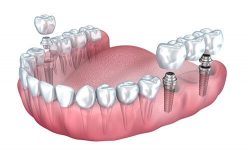 Problems Caused by Overbite