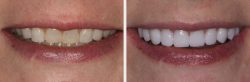 Cosmetic Dental Implants