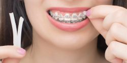 What Color Braces Should I Get? | best color for braces