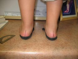 Orthotics Treatment in Oakville, ON