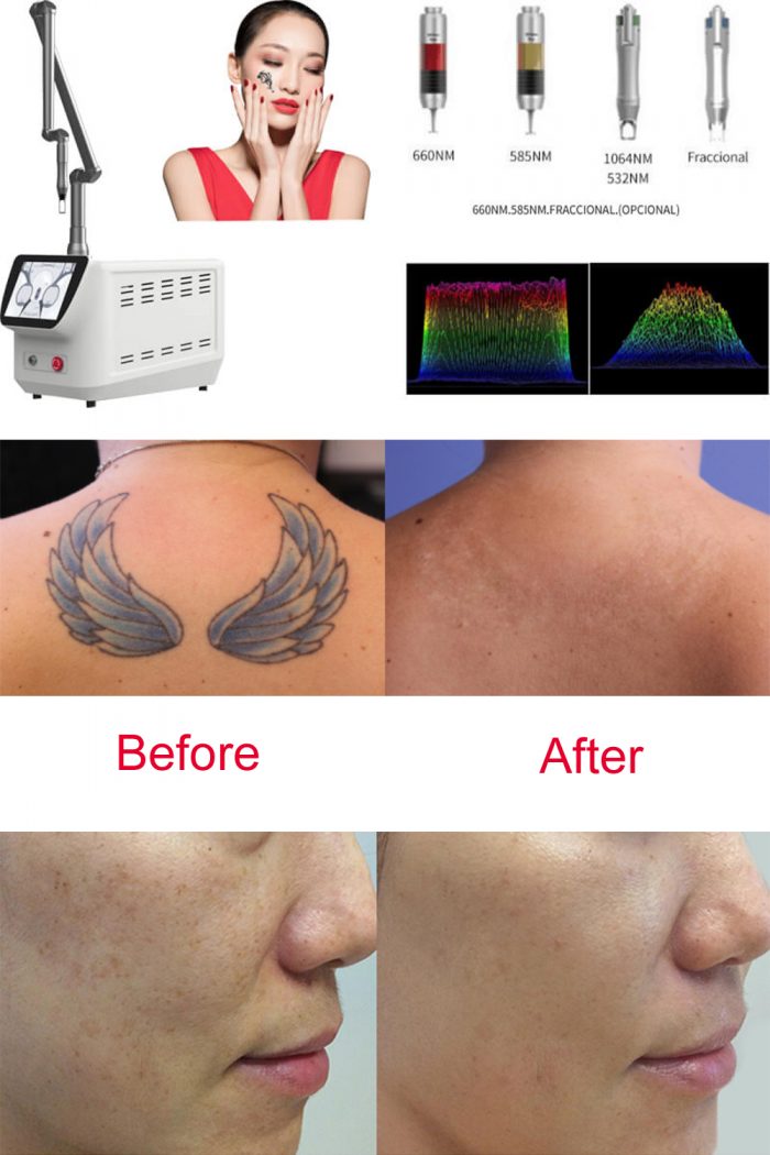 Precautions of after picosecond laser treatment