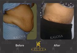 Tummy Tuck Surgery in Delhi by Dr Ashish Khare