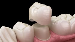 Affordable Dental Crowns Near Me | Affordable Dentist