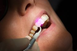 Laser Gum Surgery In Houston, TX