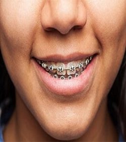 Affordable Braces In Miami Shores