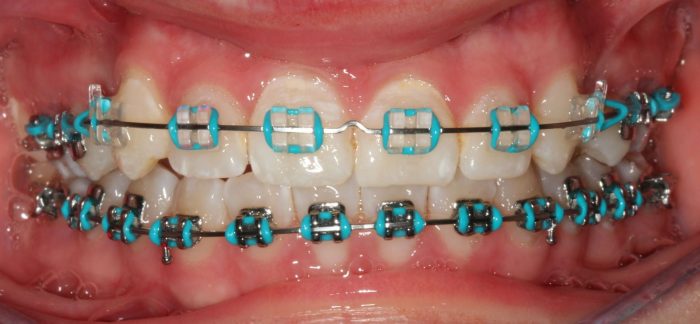 Light Blue Braces Bracket | Brackets & Braces