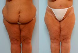 Labiaplasty and Vaginoplasty Houston, TX