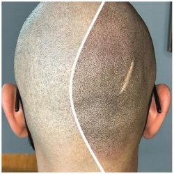 Benefits of Scalp Micropigmentation in Dubai