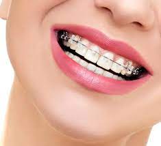 Best Braces Cost in Miami |FL