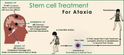 Cerebellar Ataxia Disease: Causes, Symptoms, and Treatment