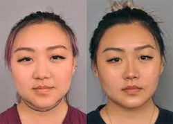 Buccal Fat Removal