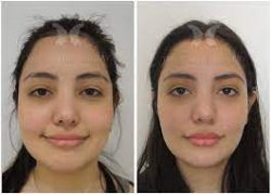 Cheekbone Reduction Surgery in Houston