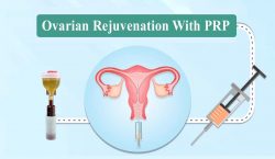 Ovarian Rejuvenation With PRP