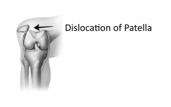 Patella Dislocations – Diagnosis, Treatment & Prevention