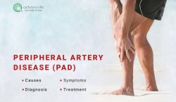 Peripheral Arterial Disease (PAD): Symptoms, Causes, Diagnosis, Treatment