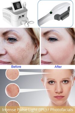 The best professional IPL machine for skin rejuvenation