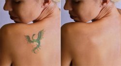 Effective Laser Tattoo Removal Services – Skin Reform – South Africa