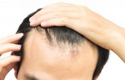 Receding Hairline – Skin Reform Hair Restoration Treatment In South Africa