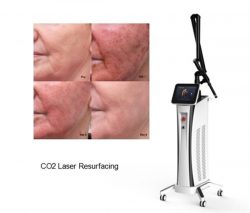 CO2 laser resurfacing