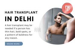 Restore Hair Volume with Hair Transplant in Delhi at SB Aesthetics