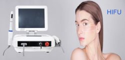 HIFU high intensity focused ultrasound for face lifting