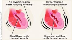 Cardiotensive Opinii!Cardiotensive Cena!