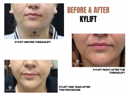 Lip Fillers San Ramon