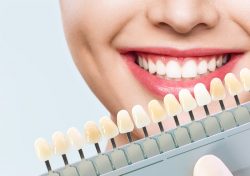 Veneers Consultation