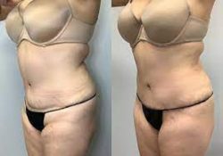 Tummy Tuck Houston Cost |Tummy Tuck