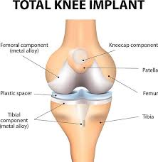 Orthopedic Surgery Tourism India & Top Orthopedic hospital in india