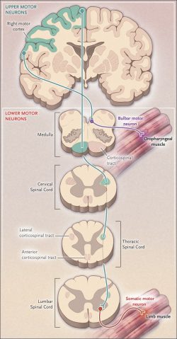 Stem Cell Therapy for Amyotrophic Lateral Sclerosis (ALS)