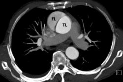 What is Aortic Dissection?