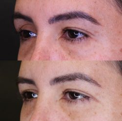 Blepharoplasty