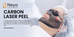 Carbon Laser Peel Treatment in Hyderabad