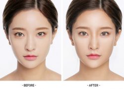 Jaw surgery in delhi | dr. Saroj k. Sheoran