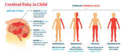 Stem Cell Treatment for Cerebral Palsy