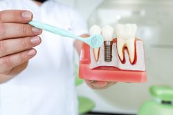 Dental implants in Delhi | dr. Saroj k. Sheoran