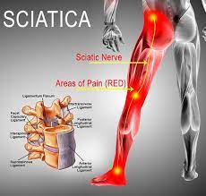 Ayurvedic Management of Sciatica