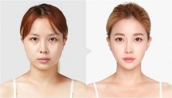 Facial feminization surgery in Delhi | dr. Saroj k. Sheoran