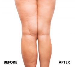 Silhouette Thread Lift in Richmond | Richmond Cosmetic & Laser