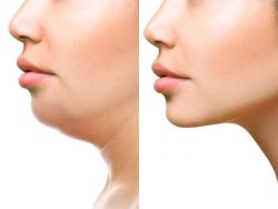 Jaw reshaping surgery in delhi | dr. Saroj k. Sheoran