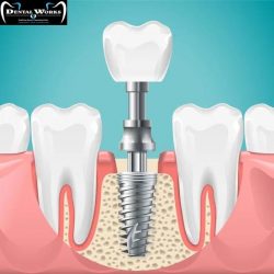 Experience Exceptional Dental Implant Services at the Best Dental Implant Clinic in Delhi