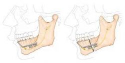 Procedure of distraction osteogenesis | dr. Saroj k. Sheoran