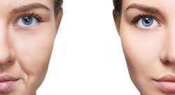 Facial Fat Grafting Procedure in Delhi | Dr. Rajat Gupta