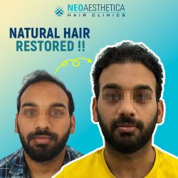 Hair Transplant Clinic In Lucknow – Neoaesthetica