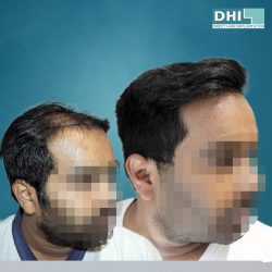 Hair Transplant in Africa – DHI International