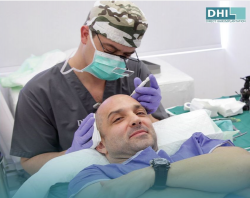 Hair Transplant in Mexico – DHI International