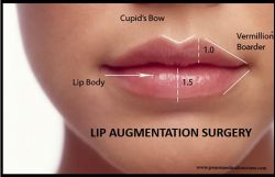 Four Facts to Know About Lip Augmentation