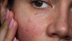 Laser Treatment for Rosacea: What to Know