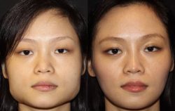 V-line jaw surgery in Delhi | dr. Saroj k. Sheoran